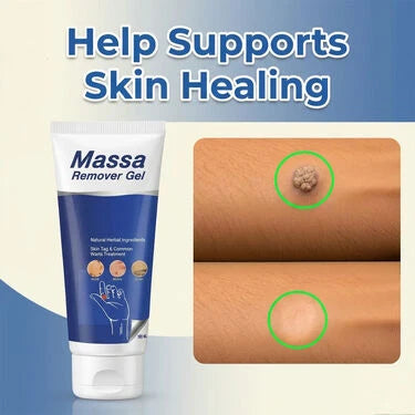 Massa Remover Gel (BCMR) – Advanced Skin Care Treatment for Clear, Smooth Skin