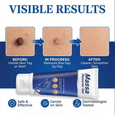 Massa Remover Gel (BCMR) – Advanced Skin Care Treatment for Clear, Smooth Skin